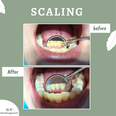 Scaling - GTC Dental Ipoh Garden