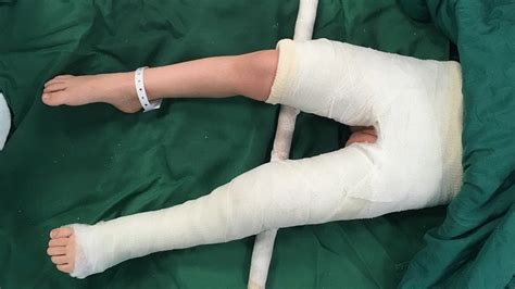 Spica Cast: When, How, and for What Purpose They Are Used