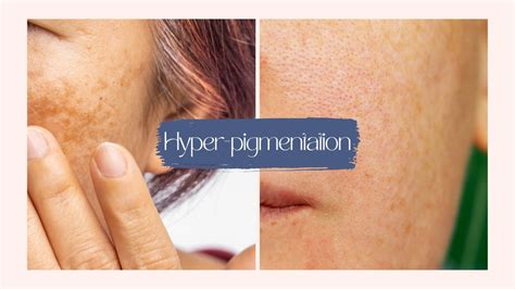 Microneedling for Hyperpigmentation - SkinBay
