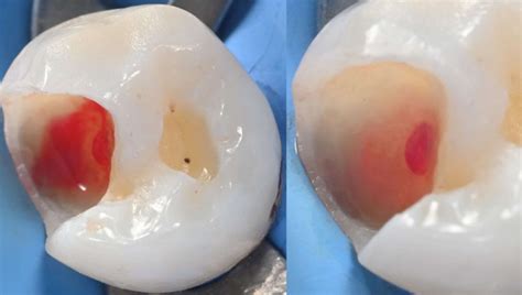 Direct Pulp Capping with BIOBulk technique - Styleitaliano.org